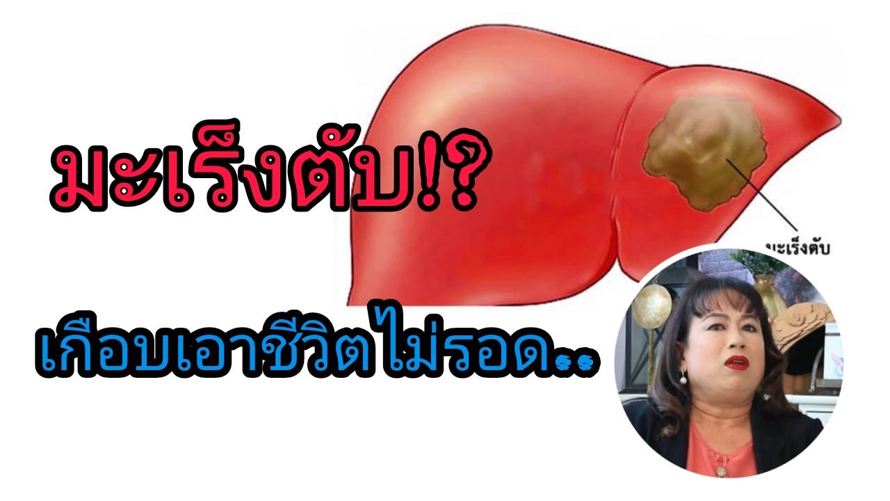 มะเร็งตับระยะ 3 ลุกลาม4