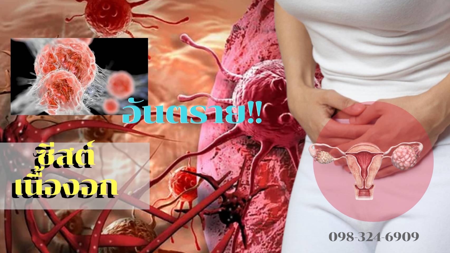 ซีสต์ เนื้องอก รังไข่ มดลูก